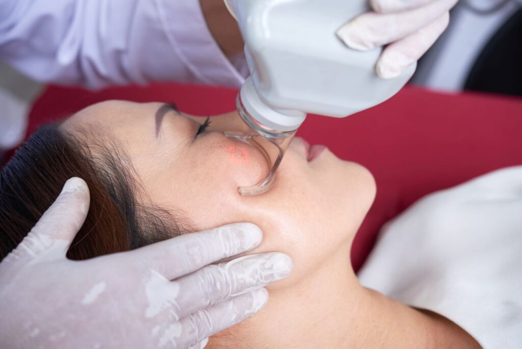 Pajączki na twarzy – sprawdź, jak działa laserowe zamykanie naczynek 17 Pajaczki na twarzy – sprawdz jak dziala laserowe zamykanie naczynek