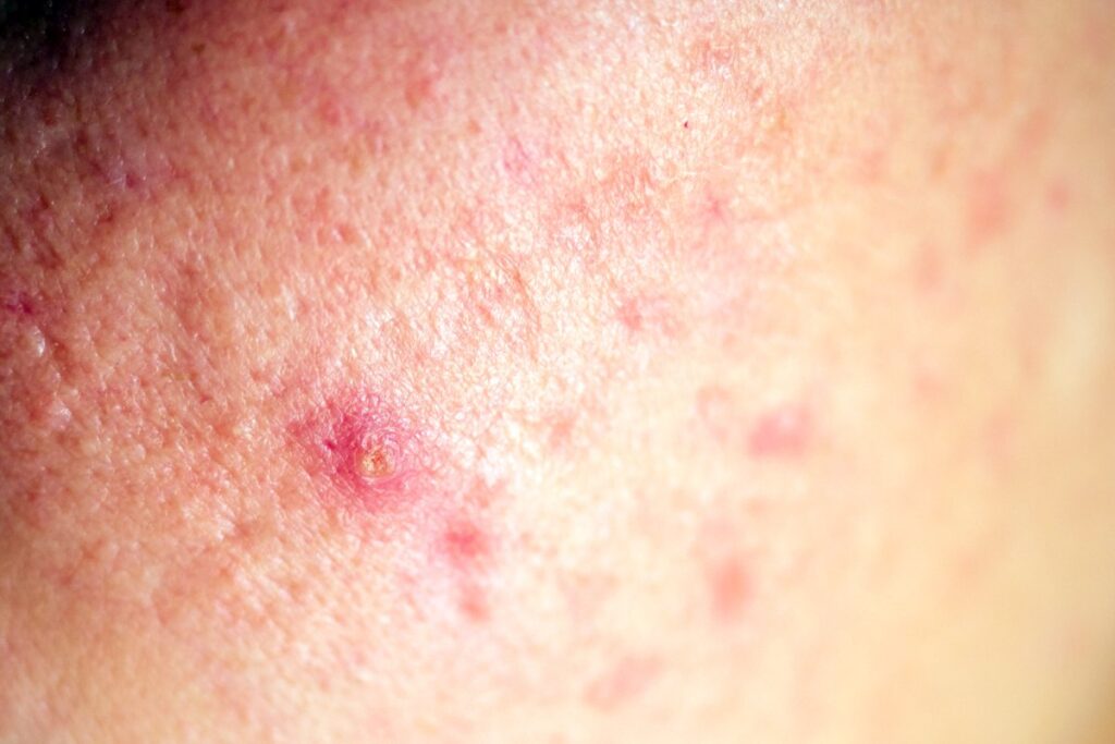 Leczenie trądziku – najskuteczniejsze metody zabiegowe 5 Leczenie trądziku – najskuteczniejsze metody zabiegowe